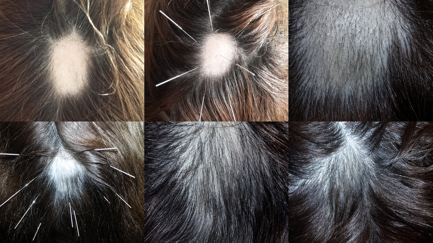 Sesión de acupuntura en cuero cabelludo para tratamiento de alopecia